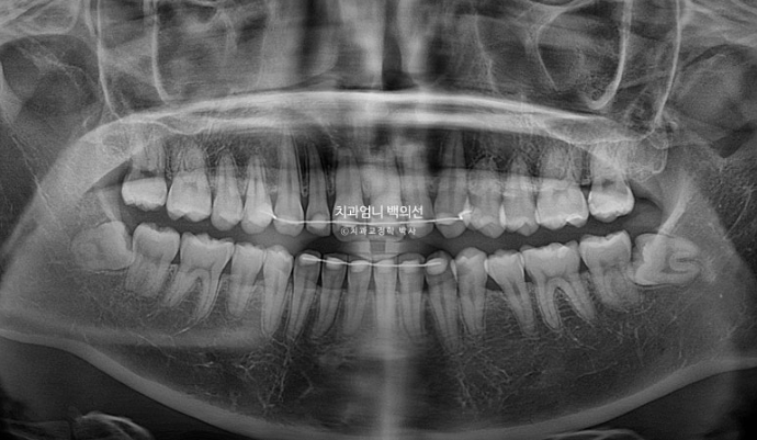 과개교합 옥니 거미스마일 교정 인비절라인 라이트 잇몸성형 후기 관련 이미지 20