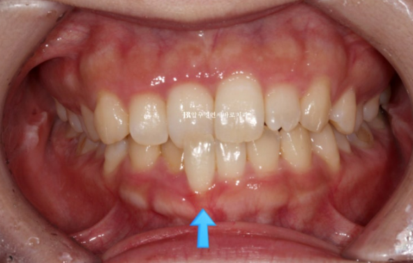 앞니부분교정 기간? MTA 미니튜브 교정 반대교합 교정 관련 이미지 1