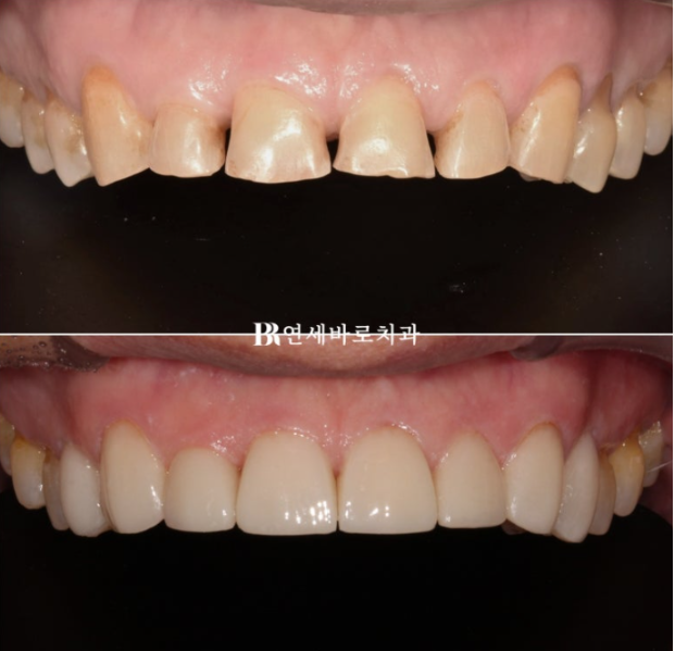 60대 무삭제 라미네이트 앞니 부분교정 치료 관련 이미지 8