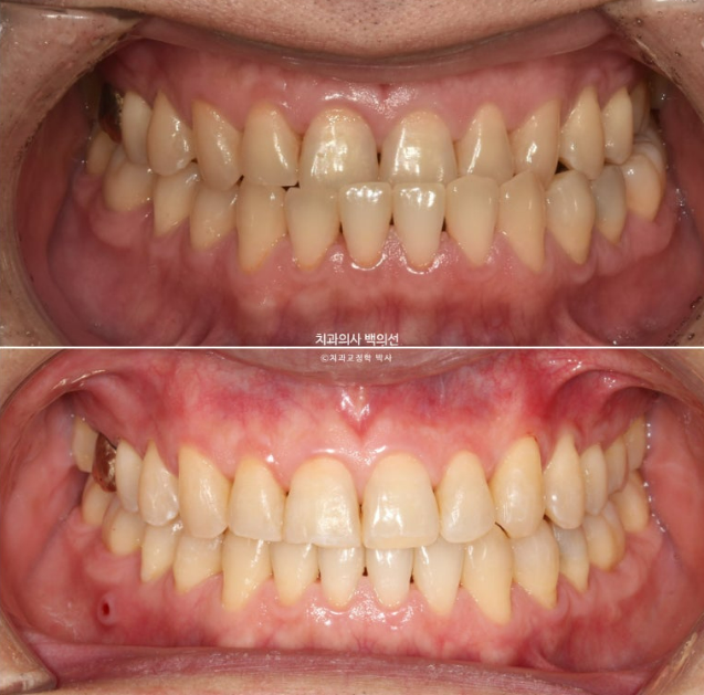 40대 인비절라인 비수술 비발치 주걱턱 비대칭 교정 관련 이미지 12