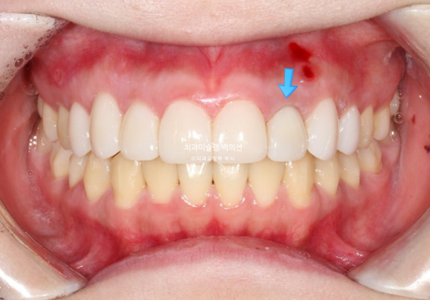 잇몸미소 인비절라인 거미스마일 토끼이빨 교정 무삭제 라미네이트 반대교합 치료 후기 관련 이미지 15