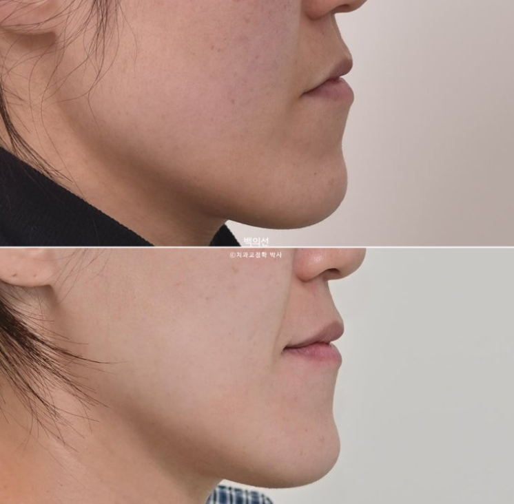 30대 비수술 비발치 주걱턱 부정교합 인비절라인 교정 관련 이미지 17