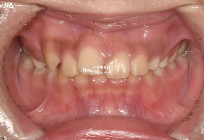 선천적 결손 잔존유치 과개교합 돌출입 인비절라인 퍼스트 어린이 투명교정 치료기간 관련 이미지 2