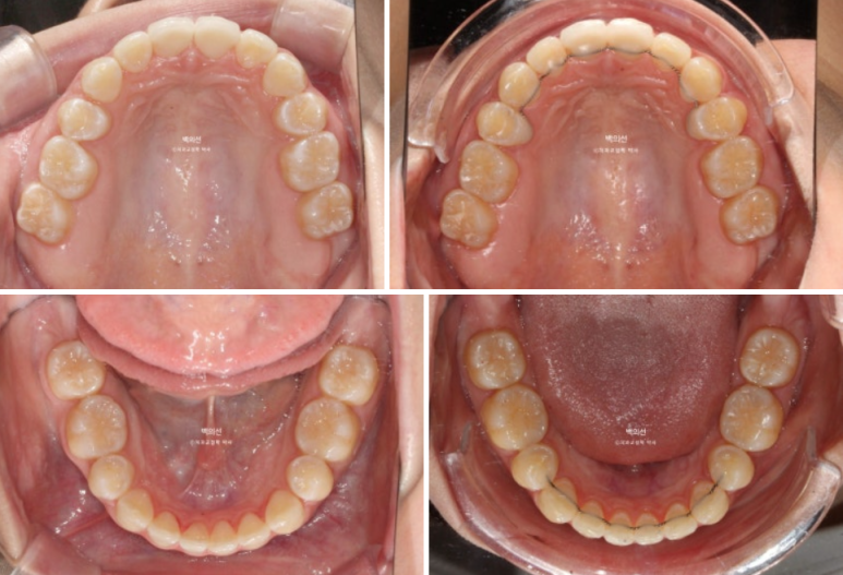 클리피씨 교정에서 인비절라인 변경 마무리 인비절라인 라이트 치료기간 4개월 관련 이미지 11