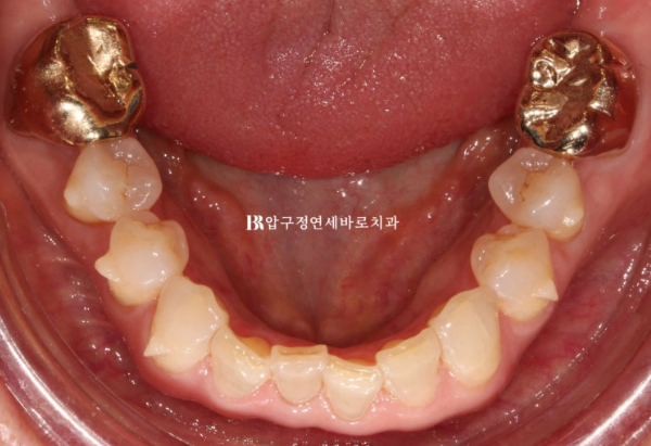 50대 인비절라인 라이트 교정 사례|왜소치·과개교합 개선 후 무삭제 라미네이트까지 관련 이미지 8