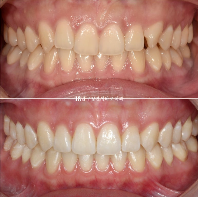 옥니 교정 인비절라인 라이트 옹니 덧니 치료기간 ? 관련 이미지 14