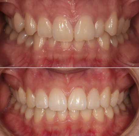 앞니 부분교정은 어떤 경우에 가능한가요? 단기 앞니 부분교정 왜소치 치료 무삭제 라미네이트 관련 이미지 13