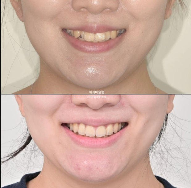 30대 인비절라인 덧니 발치교정 개방교합 치료 관련 이미지 24