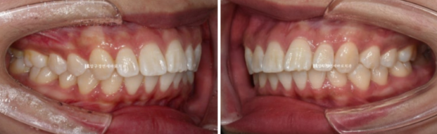 돌출입 교정 입동굴 클리피씨 교정 후기 관련 이미지 3