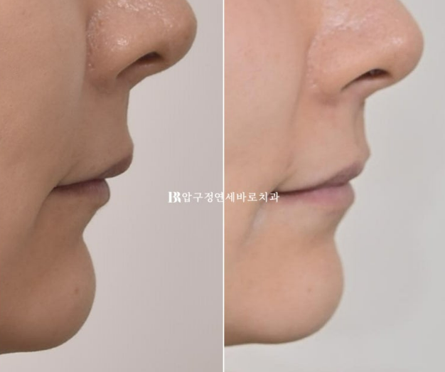 인비절라인 캔팅 교정 과개교합 교정 임플란트 재교정 관련 이미지 17