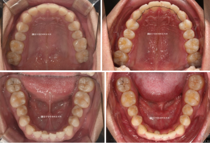 Can Invisalign Lite Correct Deep Bite and the Occlusal Plane? | A Real Case With 14 Aligners Over 4 Months image 8