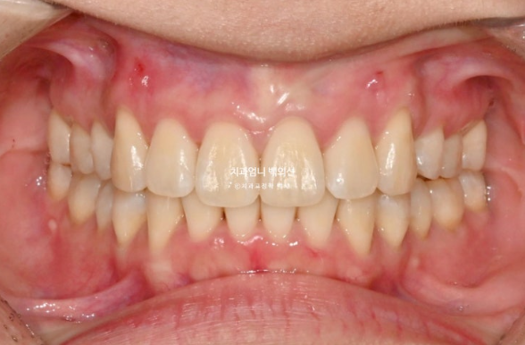 돌출입 교정 인비절라인 발치 교정 후기 관련 이미지 13