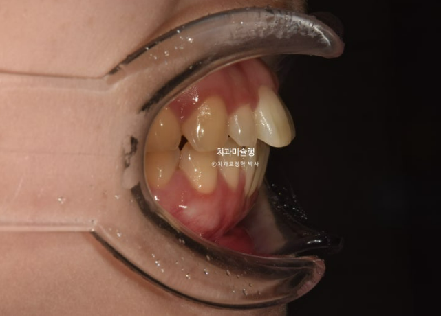 비발치 인비절라인 교정 편측 개방교합 가위교합 돌출 재교정 관련 이미지 8
