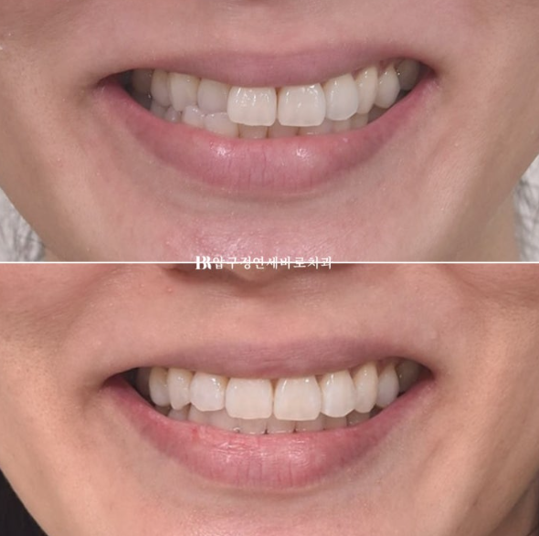 Short-Term Orthodontic Treatment Period for an Overseas Korean in Their 40s with Anterior Crossbite and Buck Teeth image 10