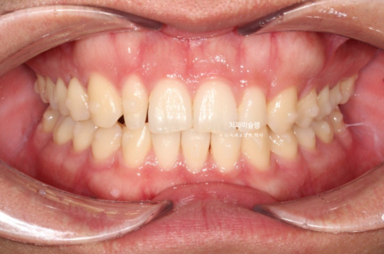 옥니 덧니 교정 왜소치 선천적 결손 3전치 무삭제 라미네이트 인비절라인 교정 관련 이미지 10