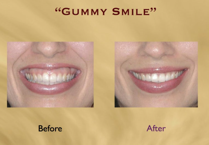 잇몸미소 거미스마일 원인에 따라 다른 치료방법? 관련 이미지 8