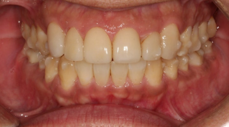 40대 중년 치아교정 인비절라인 라이트 치료기간 8개월 관련 이미지 6