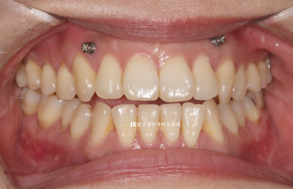 양악수술 선수술 교정 후기 인비절라인 교정 관련 이미지 4