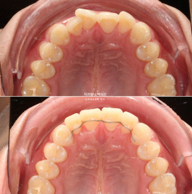 앞니 부분교정 덧니 교정 블랙트라이앵글 부정교합 마모 시뮬레이션 치료기간 5개월 관련 이미지 16