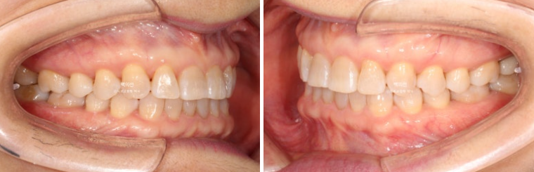 50대 치아교정 :: 인비절라인 익스프레스 치아 벌어짐 단기교정 후기 관련 이미지 14