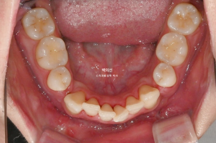 돌출입 수술 ASO + 인비절라인 라이트 후교정 치료기간 10개월 관련 이미지 6
