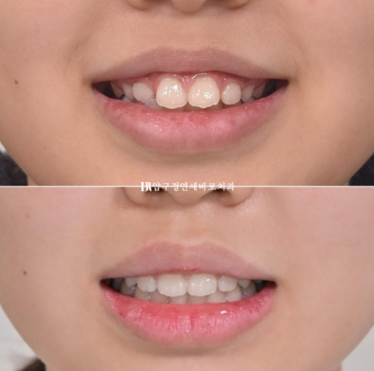 강남 소아교정 인비절라인 퍼스트 어린이 반대교합 관련 이미지 15