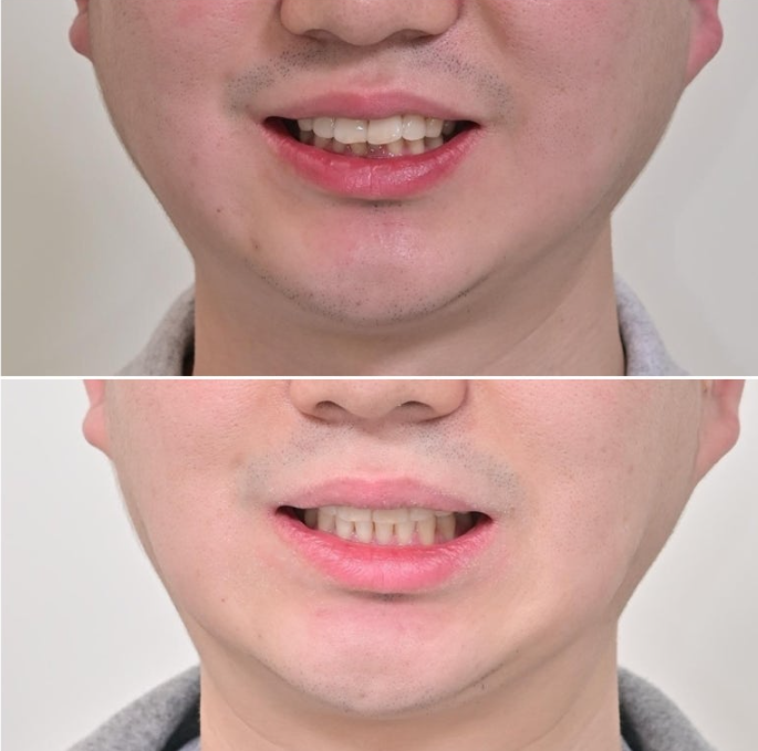 인비절라인 라이트 돌출 과개교합 중심선 교정 치간삭제 치료기간 관련 이미지 17