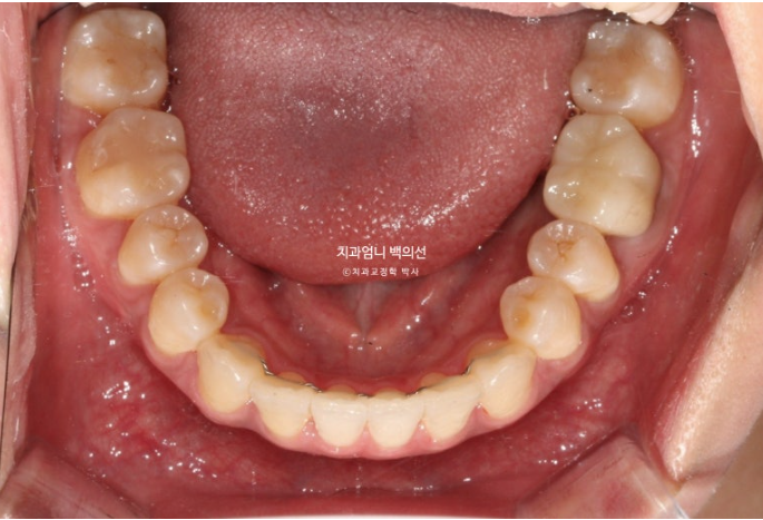 비발치 교정 덧니 인비절라인 교정 절단교합 반대교합 치료기간 1년 6개월 관련 이미지 20