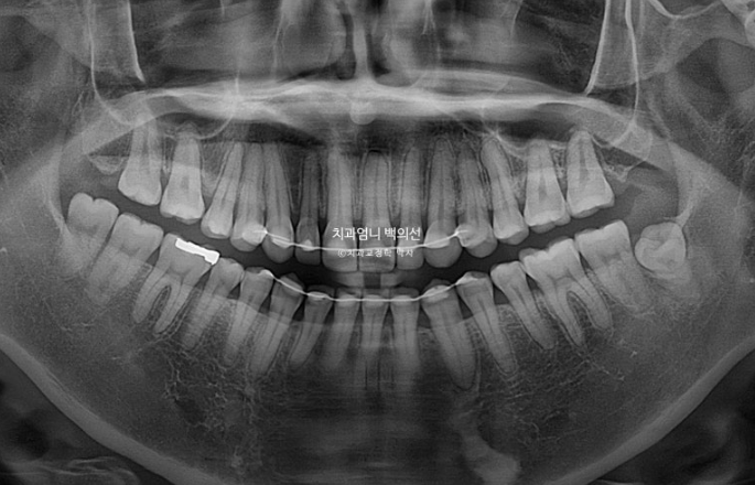 비수술 개방교합 클리피씨 30대 무삭제 라미네이트 치료기간 2년 관련 이미지 21