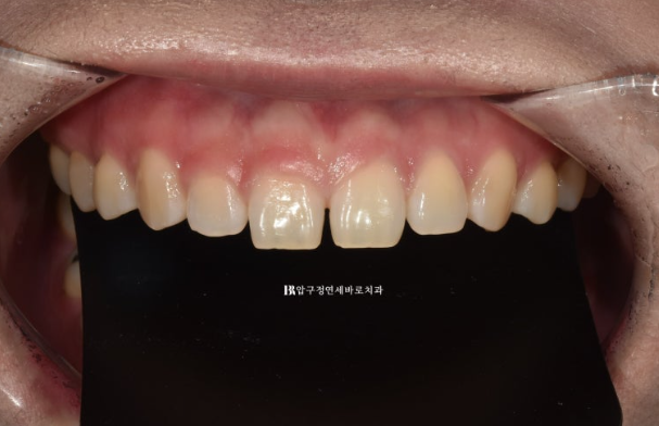 If Your Front Teeth Look Spaced Due to Peg-Shaped Teeth or Microdontia: A Case Choosing No-Prep Veneers Instead of Orthodontic Treatment image 2