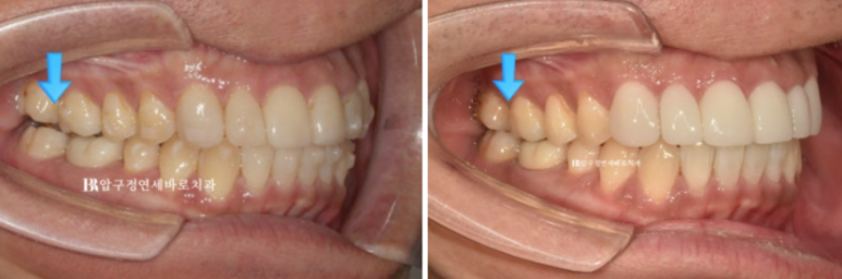 40대 치아교정 인비절라인 라이트 덧니 교정 어금니 교합 부작용 관련 이미지 10