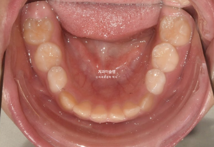 선천적 결손 잔존유치 과개교합 돌출입 인비절라인 퍼스트 어린이 투명교정 치료기간 관련 이미지 5