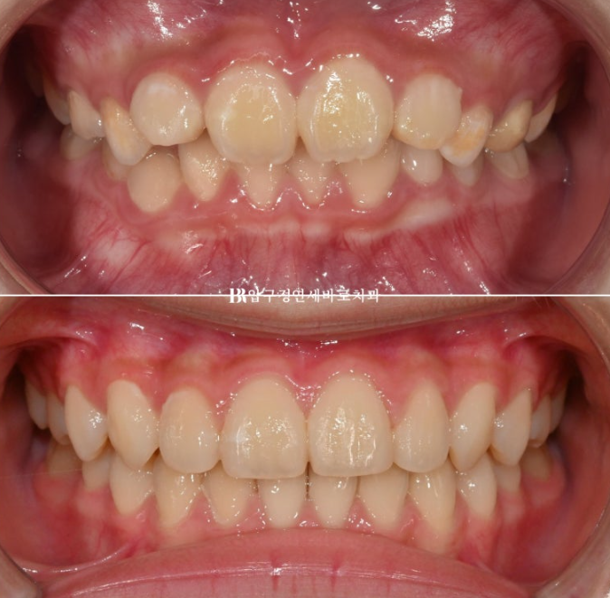 어린이교정 투명교정 인비절라인 퍼스트 후기 관련 이미지 1