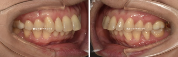 Can Invisalign Lite Work for Patients in Their 40s? A Real Case Improving Scissor Bite and Deep Bite in 10 Months image 4