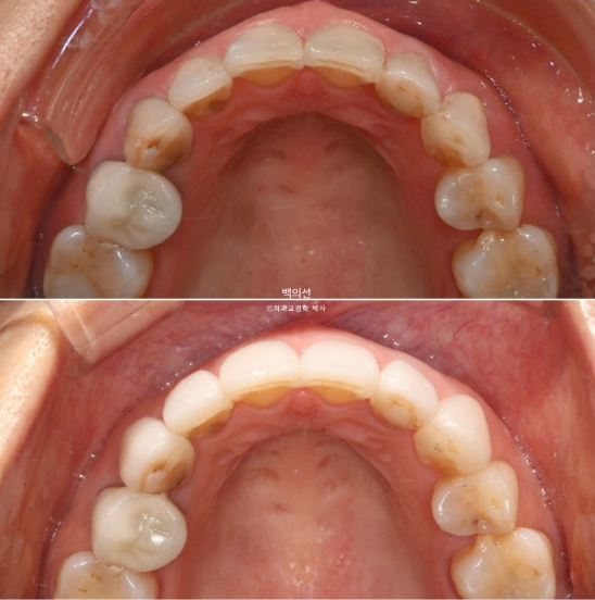40대 무삭제 라미네이트 블랙트라이앵글 레진 치료 관련 이미지 10