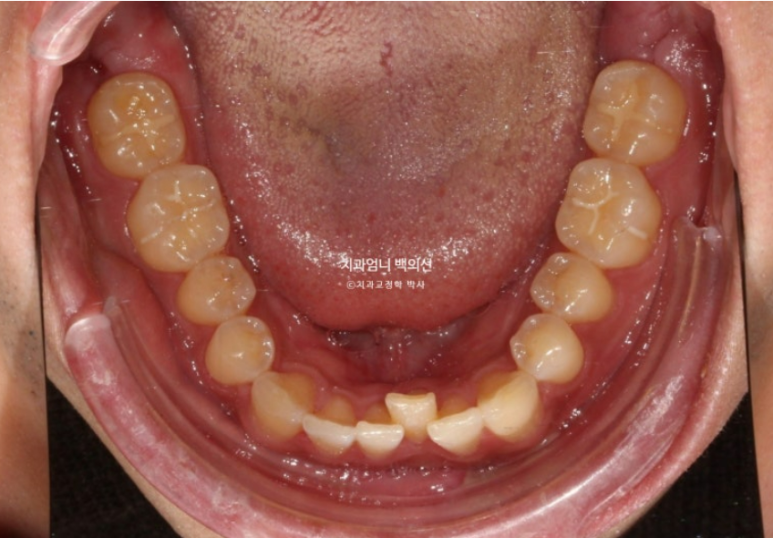 앞니 부분교정 덧니 교정 블랙트라이앵글 부정교합 마모 시뮬레이션 치료기간 5개월 관련 이미지 5
