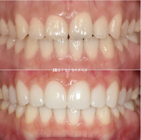 Non-Prep Veneer Review | A Case Naturally Improving Gaps Between the Front Teeth and the Smile Line image 15