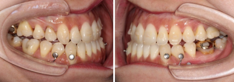 30대 비수술 비발치 주걱턱 부정교합 인비절라인 교정 관련 이미지 7