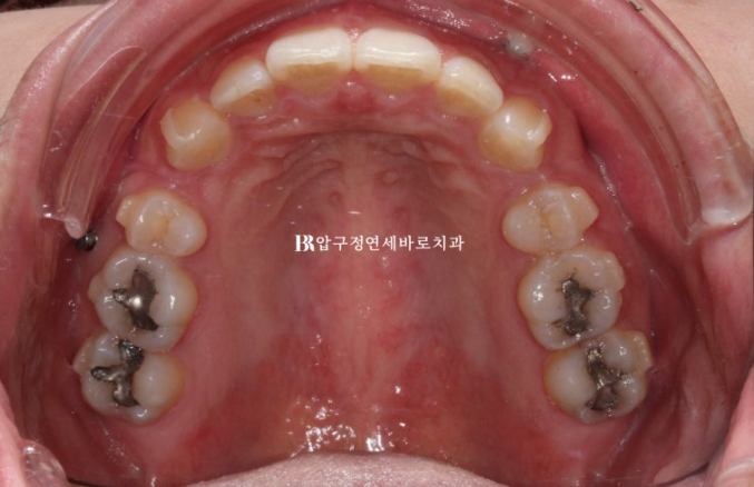 인비절라인 돌출입 발치교정 거미스마일 잇몸미소 교정 관련 이미지 5