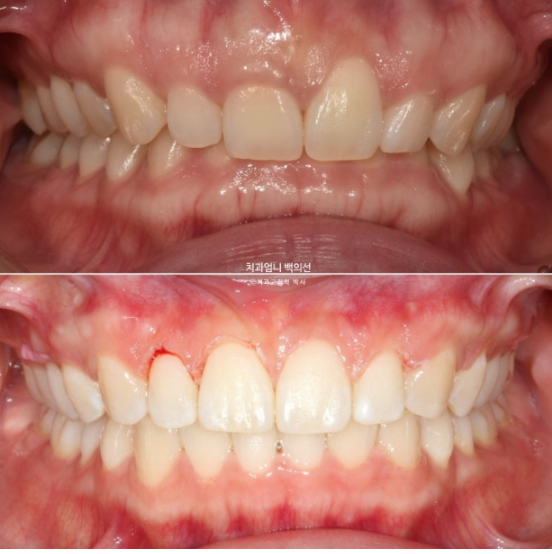 Inward-Tilted Teeth Orthodontic Treatment Review | Actual Case Improved with Non-Extraction Orthodontic Treatment for Gummy Smile, Deep Overbite & Gum Asymmetry — Gangnam Orthodontic Clinic image 14