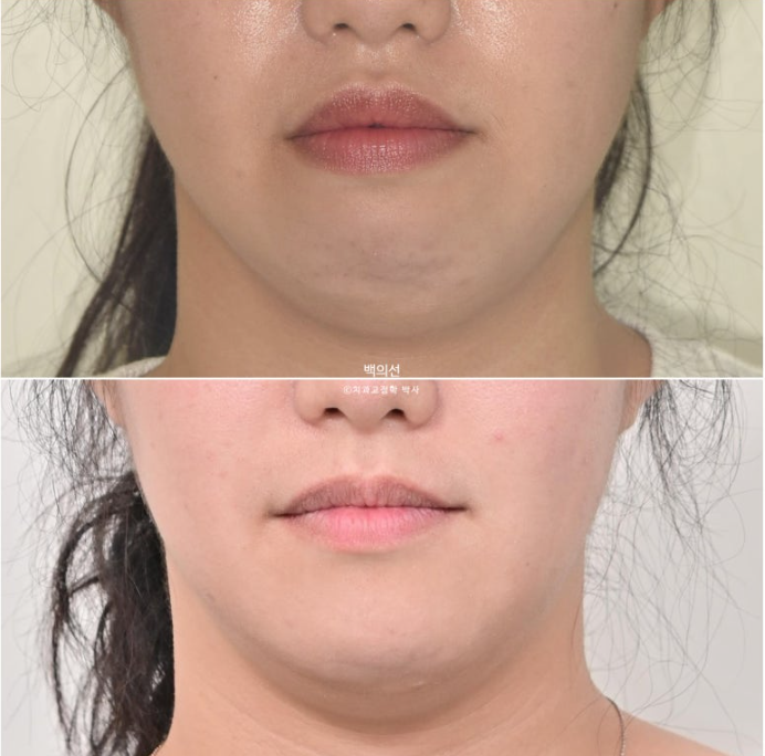 30대 치아교정 돌출입 교정 :: 잇몸미소 거미스마일 교정 입술부전증 결손치 무턱교정 관련 이미지 22