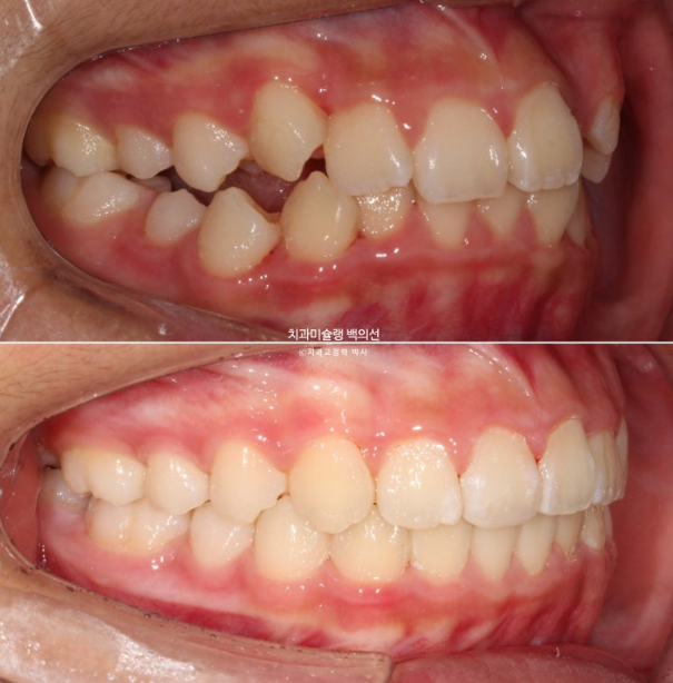 덧니 반대교합 과개교합 인비절라인 퍼스트 악궁확장 어린이 교정 관련 이미지 23