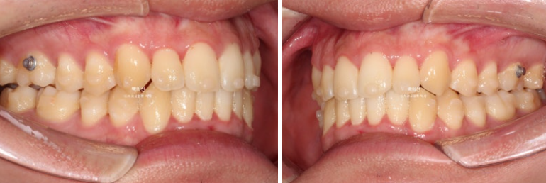 유학생 교정 인비절라인 라이트 치료기간 5개월 관련 이미지 7