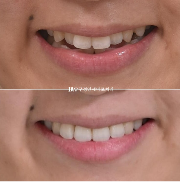토끼이빨도 부분교정이 가능할까요? 30대 앞니 반대교합 6개월 치료 사례 관련 이미지 11