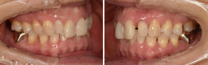 Can It Be Done in Your 50s? Real Results from Limited Front Teeth Orthodontics + No-Prep Laminate Veneers Revealed image 3