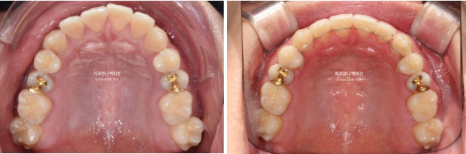 MSE Palatal Expansion Invisalign Underbite Correction, Non-Surgical image 18