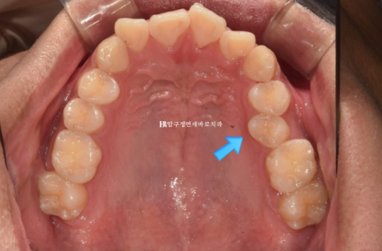 인비절라인 라이트 교정 덧니 이소맹출 반대교합 관련 이미지 4