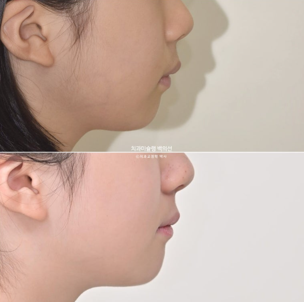 어린이 무턱 성장교정 덧니 인비절라인 퍼스트 악궁확장 치료기간 2년 관련 이미지 36