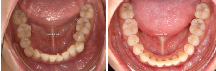 옥니 덧니 과개교합 반대교합 중심선 인비절라인 치료기간 1년 관련 이미지 17