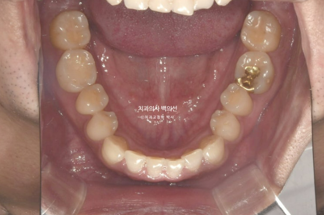 30대 주걱턱 비수술 비발치 교정 후기 관련 이미지 5